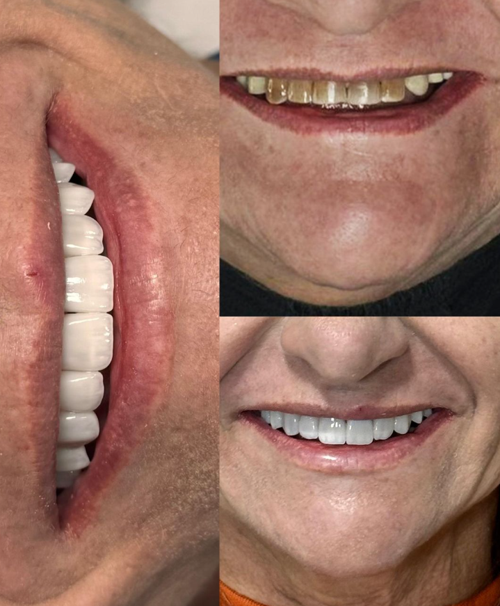 Antes e depois de tratamentos dentários - transformações reais